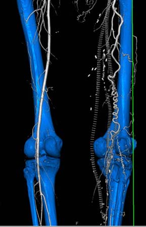 CTA image of the thigh.