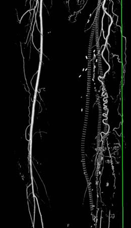 Angiography image of the thigh.