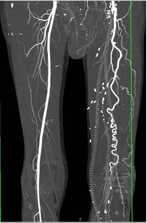 Angiography image of the thigh.