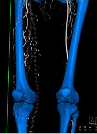 3-D CT angiography image of the thigh.