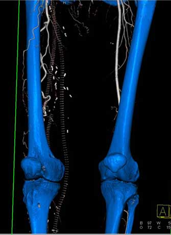 Imagen 3-D por angiotomografía computarizada del muslo.