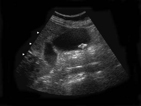  Imagen de ultrasonido que muestra un cálculo biliar.