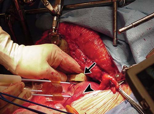 Photo of ultrasound probe used to guide microwave applicators.