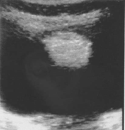 Ultrasonido de la vejiga en un niño con hematuria.