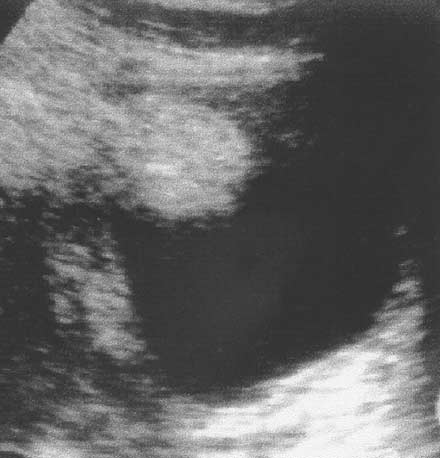 Ultrasound of the bladder in a child with hematuria.