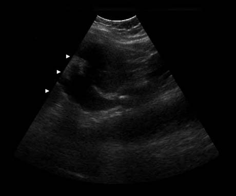 Imagen por ultrasonido mostrando una piedra en el riñón (flecha) que está obstruyendo el flujo de la orina.