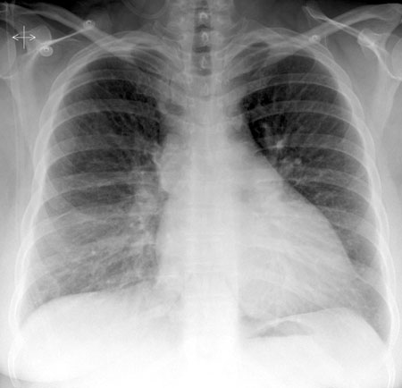 Chest x-ray