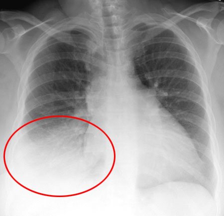 Rayos X del pecho mostrando neumonía.