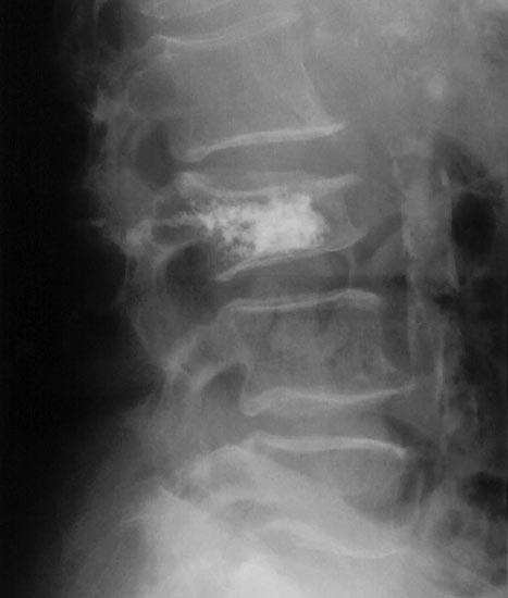 Rayos X laterales de la columna lumbar en un paciente con osteoporosis que muestra vertebroplastia.