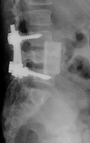 Rayos X laterales de la columna lumbar mostrando tornillos pediculares con varillas conectoras en cada lado. 