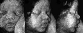 Three dimensional ultrasound images of a baby's face.