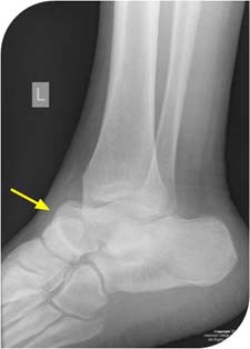ankle x-ray