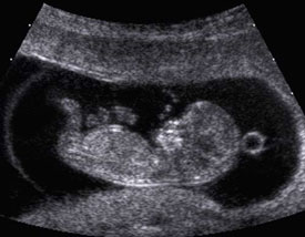 Ultrasound of a baby.