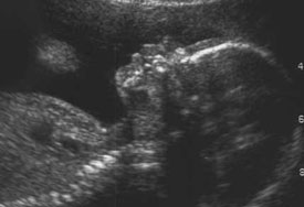 Ultrasound of a fetus.