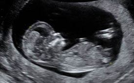 Ultrasound of a fetus.